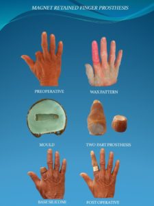 finger prosthesis